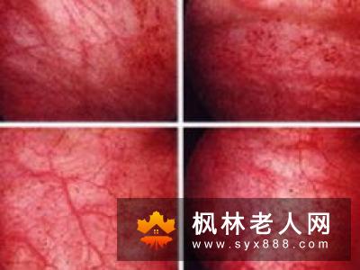 男性无法幸免尿道炎 预防有妙招