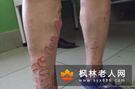 静脉曲张怎么治疗