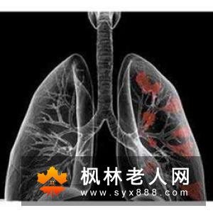 如何治疗精神分裂