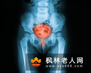 尿频、尿急、尿痛、排尿困难、腺性膀胱炎误诊