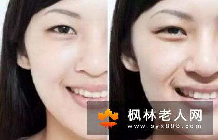 某些疾病会导致黑眼圈  病理性的黑眼圈怎么办