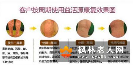 静脉曲张怎么治疗