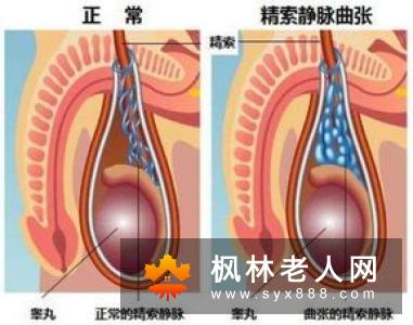 男性患精索静脉曲张的主要危害有哪些