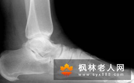 骨刺应该如何拔刺？这样治疗即可