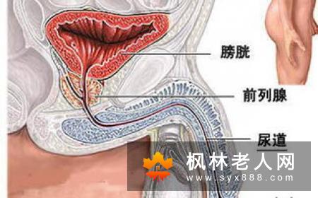 男性无法幸免尿道炎 预防有妙招