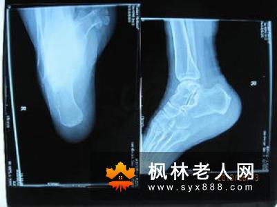 骨刺应该如何拔刺？这样治疗即可
