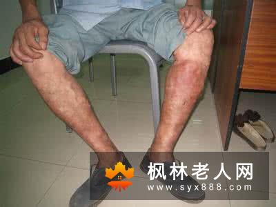 男性患精索静脉曲张的主要危害有哪些