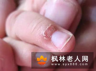 割包皮后水肿不能忽视 有效消除割包皮后水肿