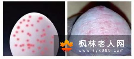 包皮龟头炎的症状有什么
