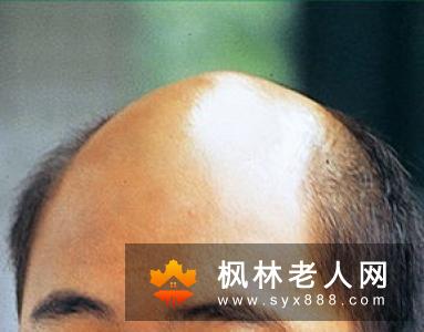 溢脂性脱发的男性有哪些常见的特征