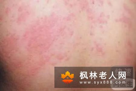 慢性荨麻疹如何调理 聪明的患者会这几招