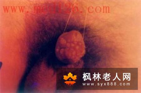 如何判断是否是阴茎癌