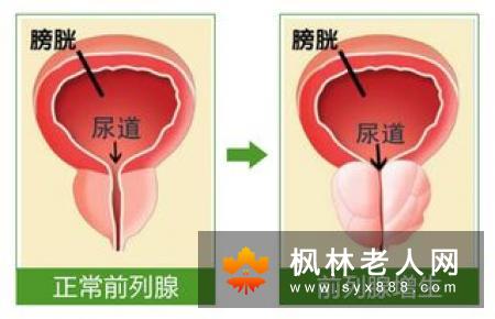 当出现这些症状时 男士们就需要提防前列腺炎的侵犯