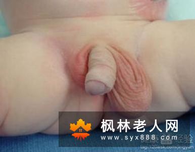 隐睾，什么时候治疗最好