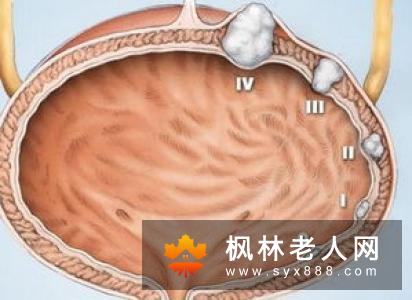膀胱里长了个肿瘤 你还能活多久