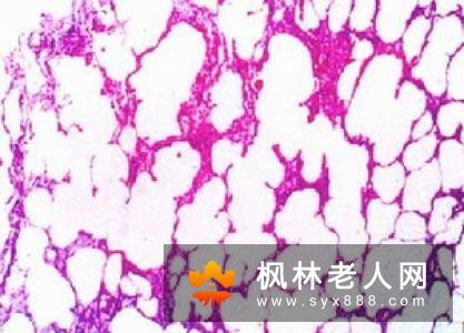 老年肺气肿饮食注意事项多 饮食宜忌有哪些