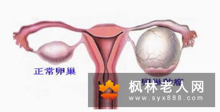 卵巢囊肿病情恶化的后果