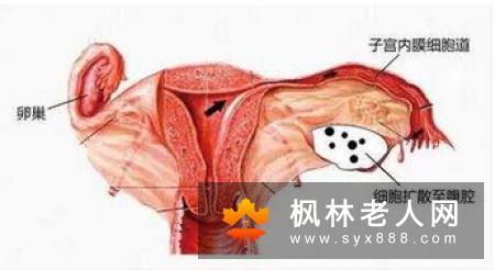 女人如何给子宫保暖 餐后喝它很管用