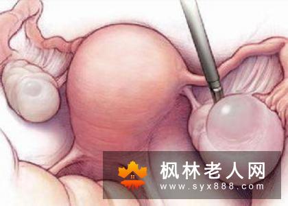 卵巢囊肿会给女性患者造成哪些危害