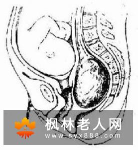 放射学诊断:要有效的治疗卵巢囊肿