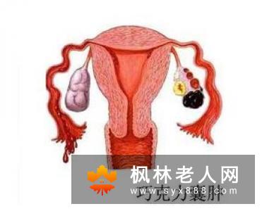 卵巢囊肿不治疗有哪些危害