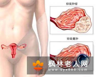 卵巢囊肿带给患者的危害是什么