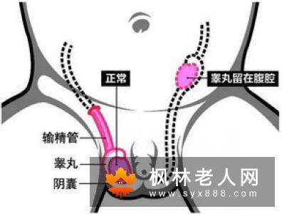 隐睾，什么时候治疗最好