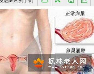 卵巢囊肿患者日常的留意事项有哪些