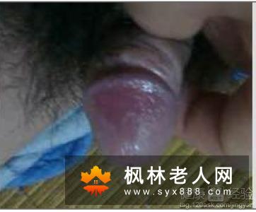 男性如何预防龟头炎 一定要避免不洁性J