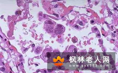 精囊炎是一种常见的男性泌尿生殖系病症