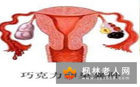 卵巢囊肿有些什么症状