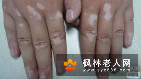 老年痴呆新的诊断法有什么?