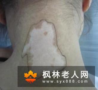 白内障给人眼睛带来的危害