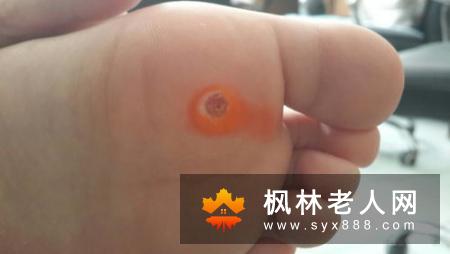老年痴呆怎么治疗？