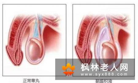 什么是念珠菌性包皮龟头炎 它有哪些症状