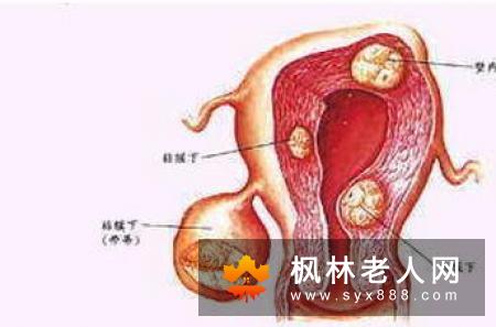 典型的卵巢囊肿症状