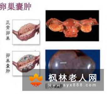 卵巢囊肿如何治疗才得当
