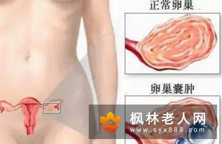 卵巢囊肿的危害有多大