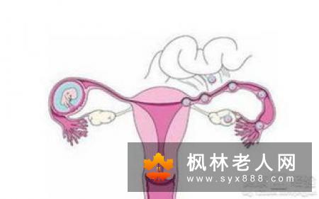 卵巢囊肿有哪些手术方式