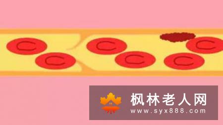 每天这样做竟能远离心绞痛！