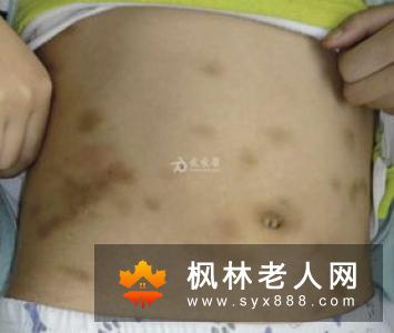 了解皮肤病的症状 关注皮肤健康问题