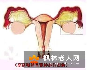 卵巢囊肿的危害严重吗