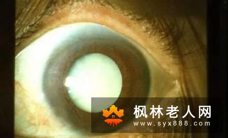 年纪大不易动手术？老年人患白内障需尽早手术
