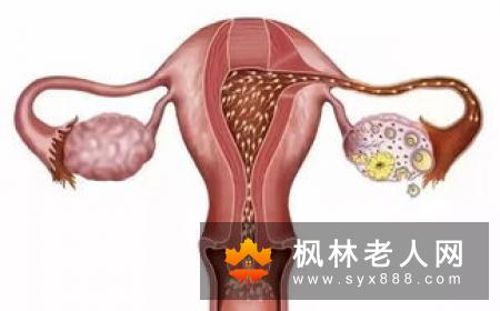 卵巢囊肿的症状你知道都有哪些吗