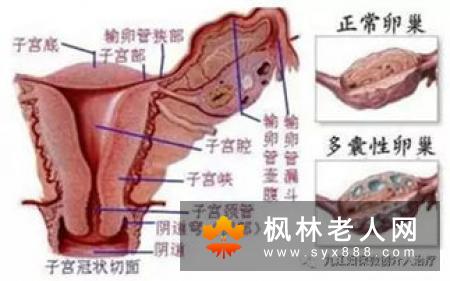 多囊卵巢综合症怎么护理