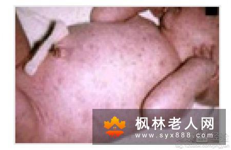 并发性白内障当积极治疗原发病