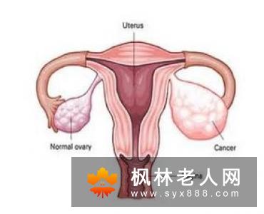 卵巢囊肿,关注女性健康,每个人都有个好的身体