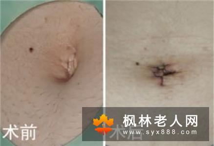 卵巢囊肿一定要动手术吗