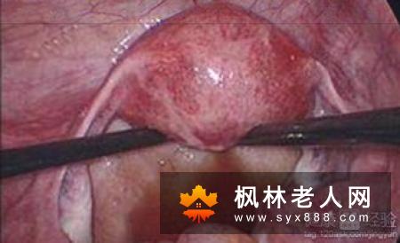 卵巢囊肿有些什么症状
