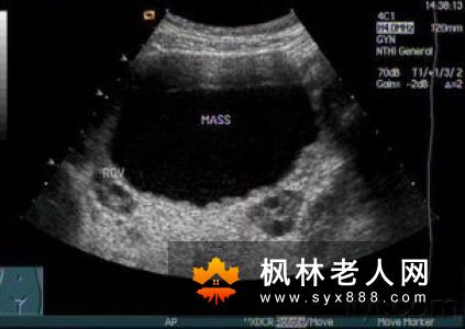 卵巢切除不会防碍性事